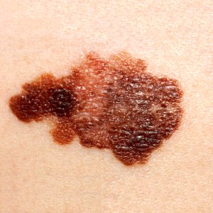 Melanoma (2) photo