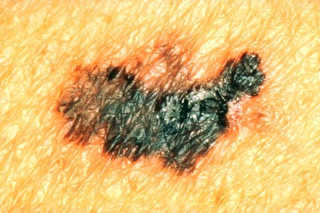 Melanoma with color differences