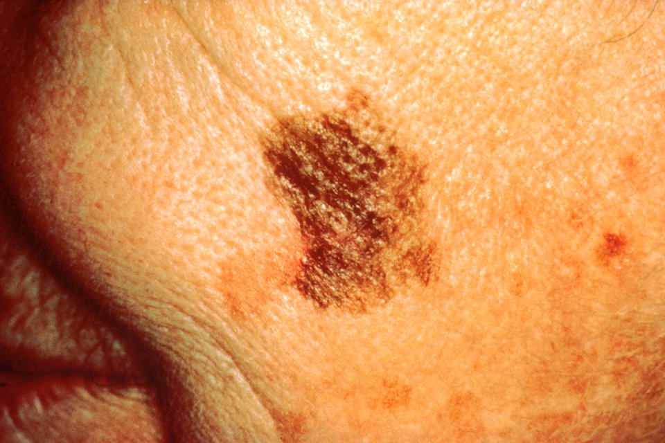 Melanoma with diameter change