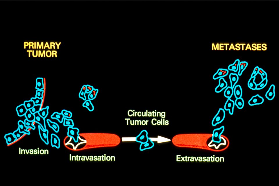 Metastasis illustration (1)
