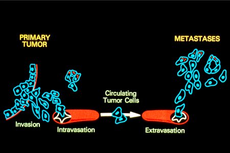 Metastasis illustration (1)
