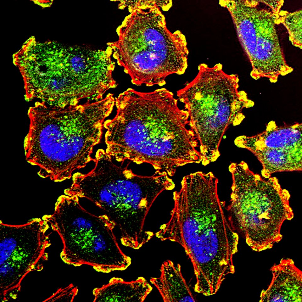 Metastatic Melanoma Cells Nci-vol-9872-300