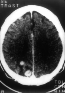 Nci-vol-2295-300 aids brain cat scan photo