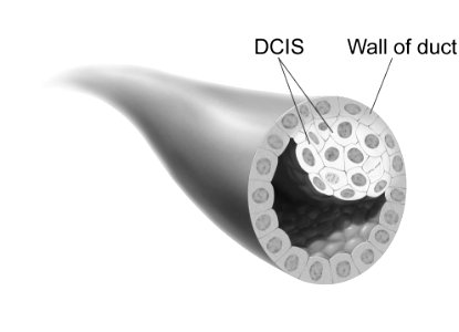 Nci-vol-4353-300 ductal carcinoma in situ photo