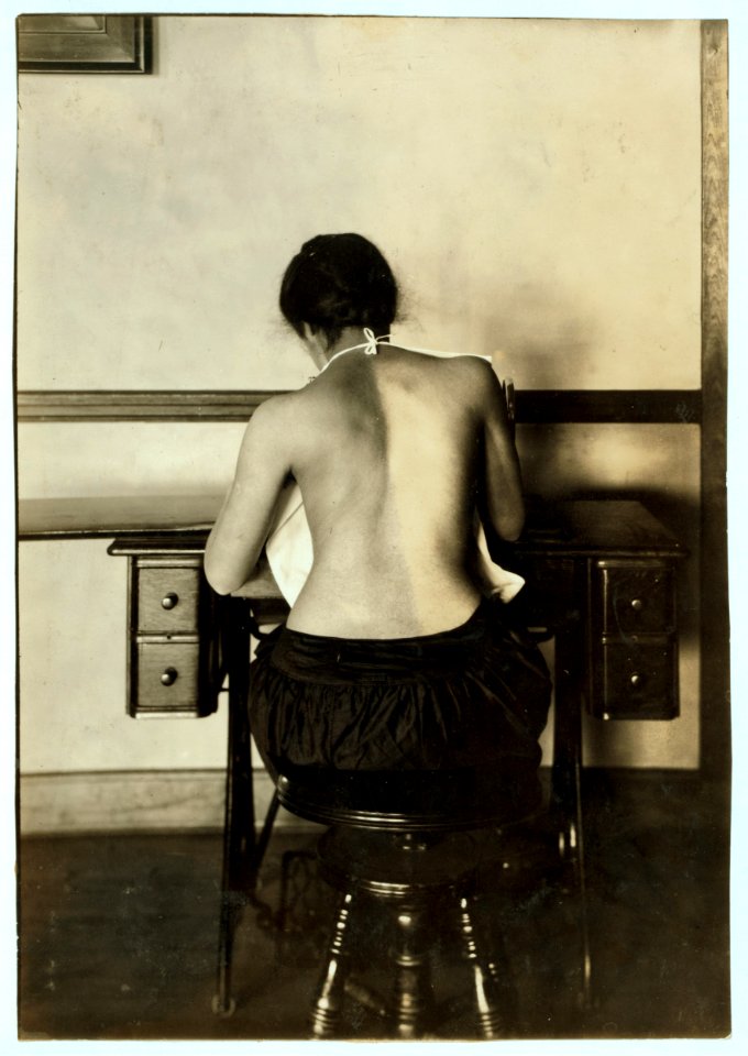 Mildred Benjamin, 17 years old. Right dorsal curvature. Scoliosis. Right shoulder higher than left. Shows incorrect position required to perform this kind of work. Stopping use of right arm. LOC nclc.05144