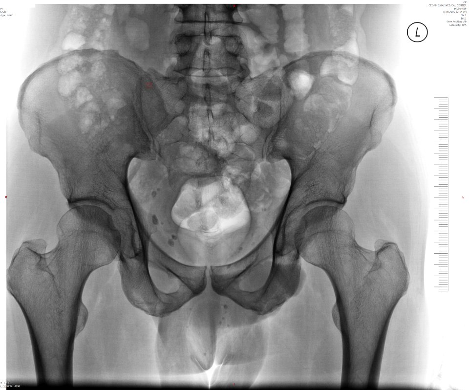 Normal adult male human pelvis