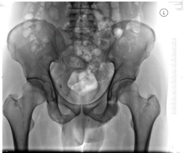 Normal adult male human pelvis