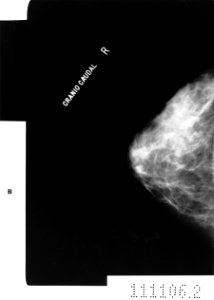Normal mammogram photo