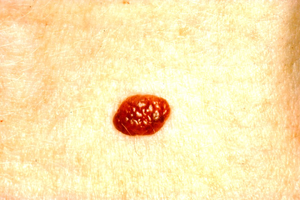 Normal mole with border