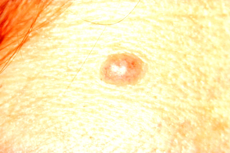Normal mole with no asymmetry