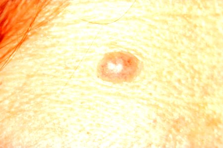 Normal mole with no asymmetry