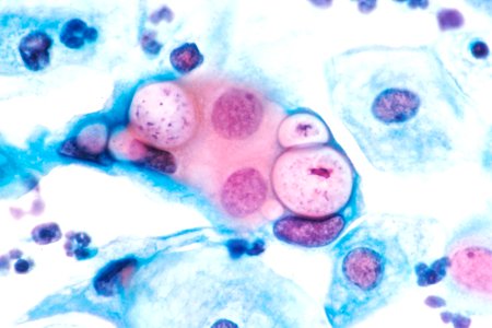 Pap smear (1)