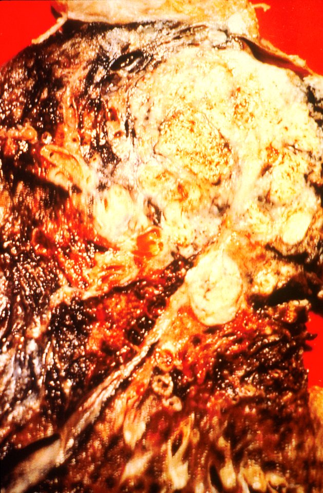 Pathology of the lung (cancer)