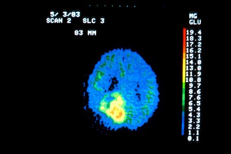 Pet scan of brain tumor photo