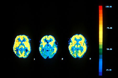 Pet scans of aids patient with dementia