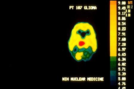 Pet scan showing brain tumor (malignant)