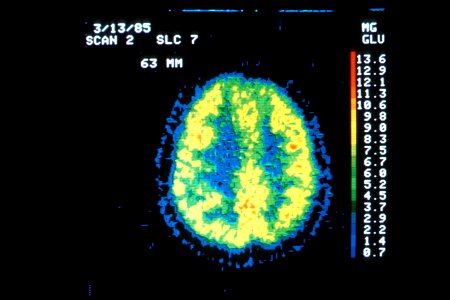 Pet scan of a normal brain photo