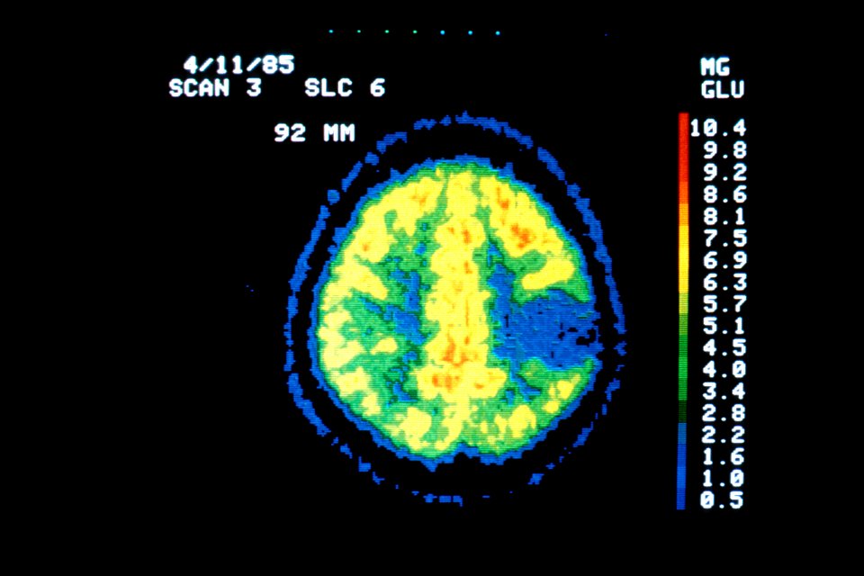 Pet scan- astrocytoma (grade 1)
