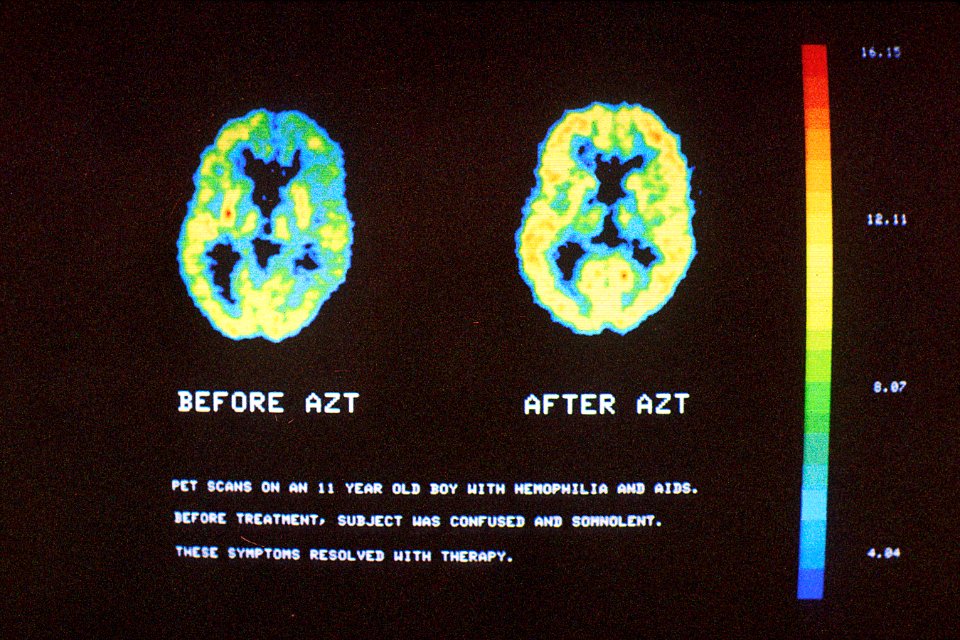 Pet scan on hemophilia and aids patient