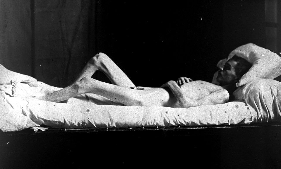 Photograph, Malta-fever patient. Wellcome L0020992