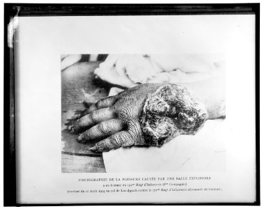 Photographie de la blessure causee par une balle explosible a un homme du 152me Regt d'Infanterie (8me Compagnie) DIACRITICS LOC hec.13618