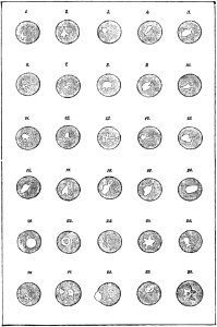 PSM V50 D653 Plasmodium changes of a blood corpuscle