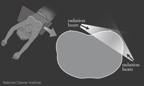 Radiation beam to chest photo