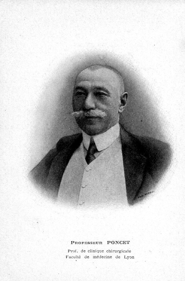Poncet