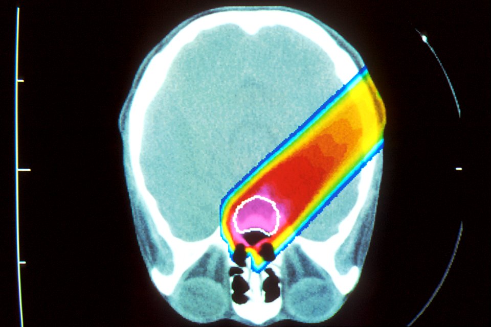 Proton beam therapy (1)