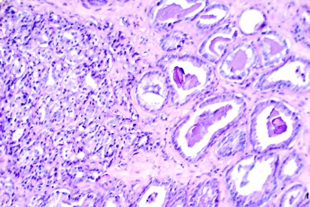 Prostate cancer (1)