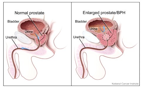 Prostate (normal and enlarged)