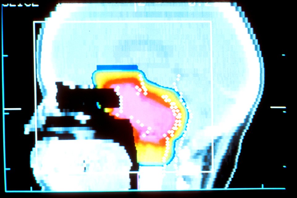 Proton beam therapy