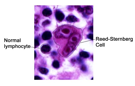 Reed-sternberg cell
