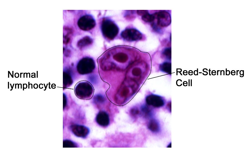 Reed-Sternberg lymphocyte nci-vol-7172-300 photo