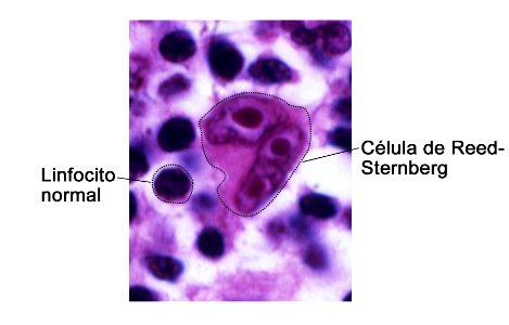 Reed-sternberg cell - spanish