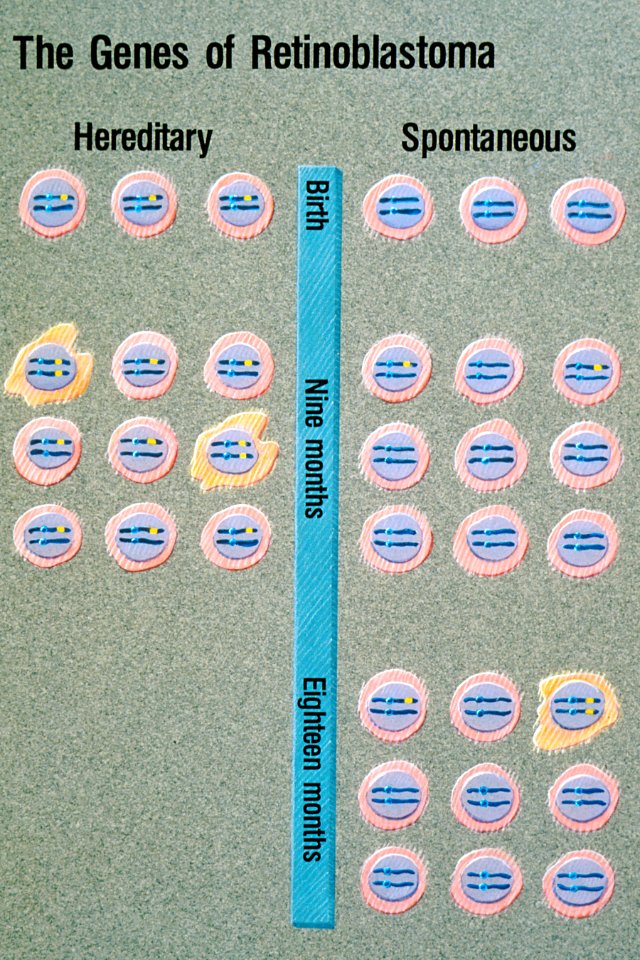 Retinoblastoma illustration