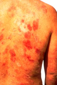 Kaposi's sarcoma after