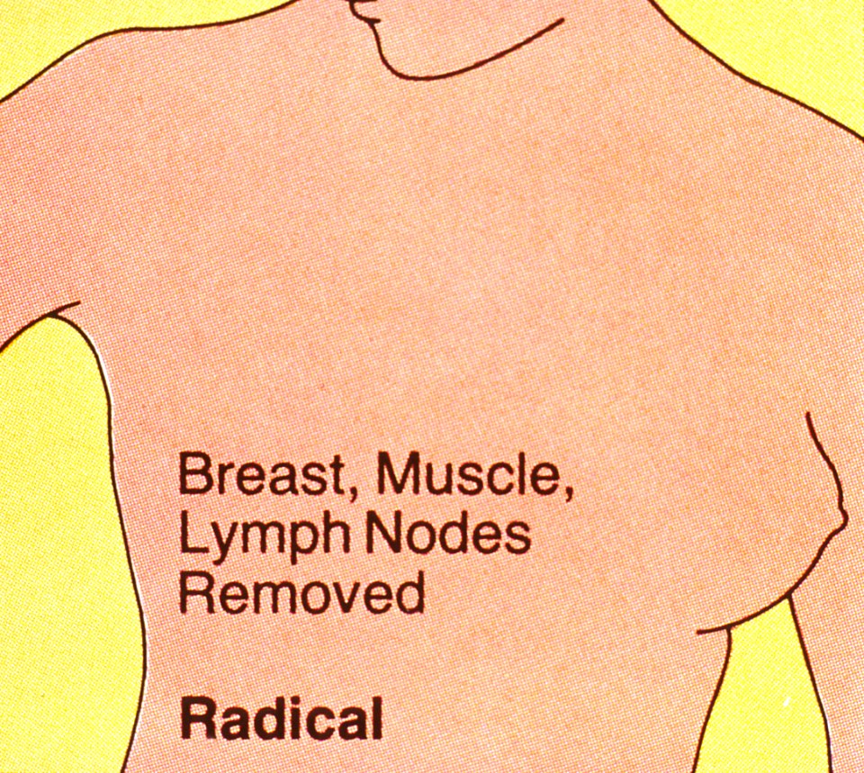 Mastectomy (radical)