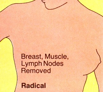 Mastectomy (radical)