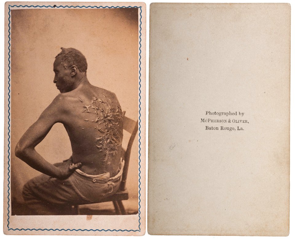 Scourged back by McPherson & Oliver, 1863