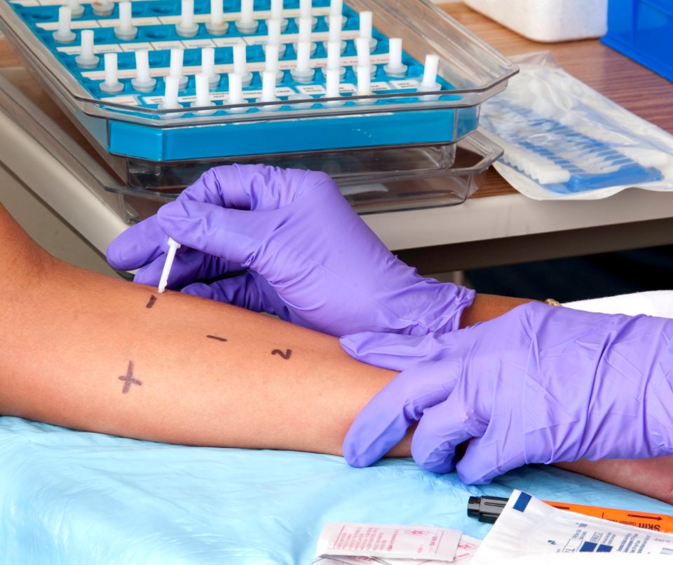 Skin prick testing for allergies