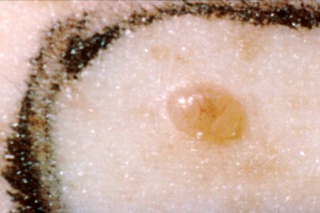 Skin cancer waxy lump