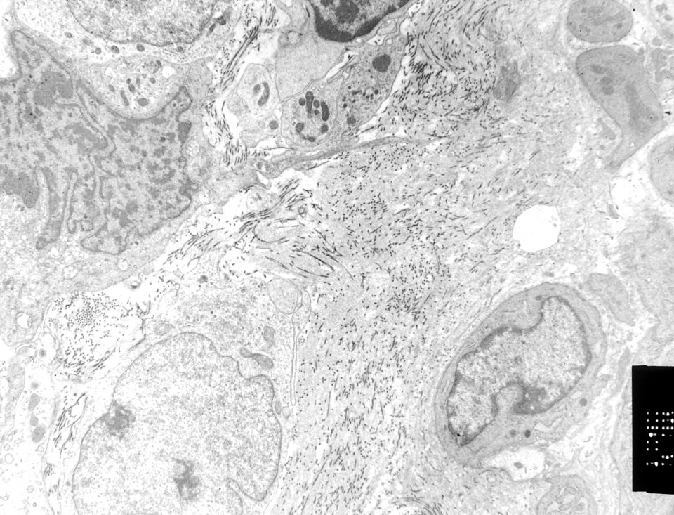 Soft tissue sarcoma