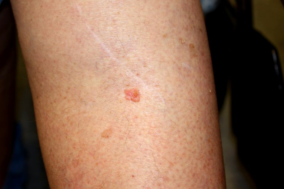 Squamous cell carcinoma (2)