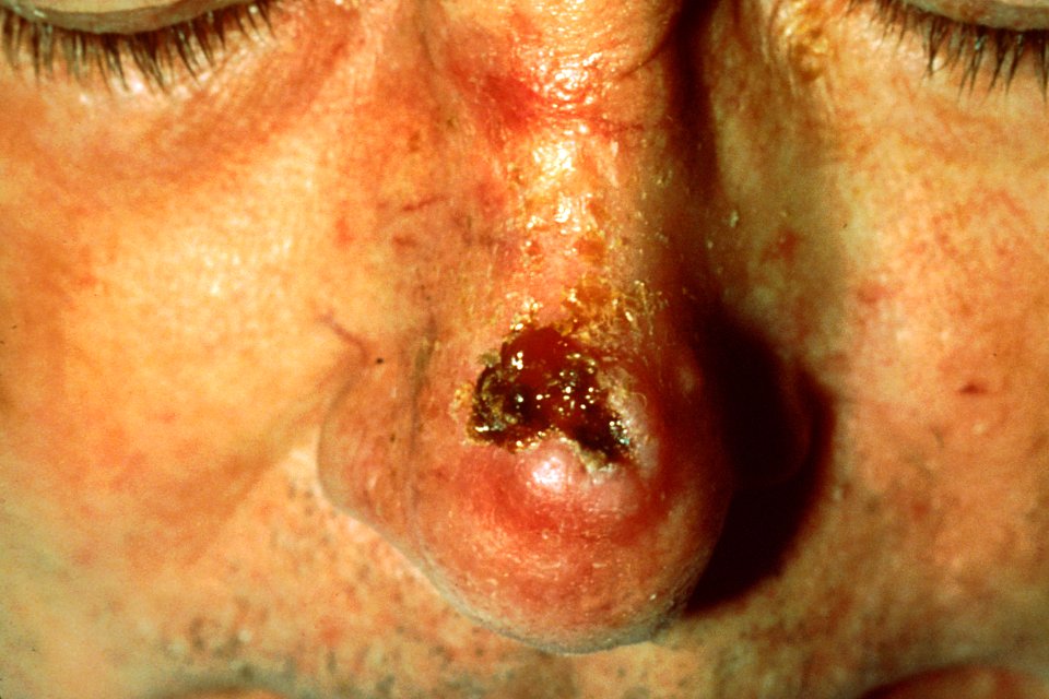 Squamous cell carcinoma (3)