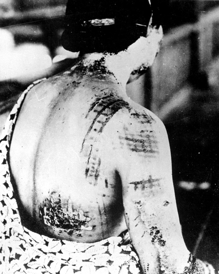 The patient's skin is burned in a pattern corresponding to the dark portions of a kimono - NARA - 519686