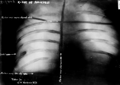 Theodore Roosevelt's medical x-ray on October 14, 1912 assassination attempt showing bullet to remain inside his body for life, from- X-Ray of Roosevelt (shows bullet) LCCN2014690853 (cropped) photo
