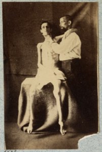 Unidentified emaciated prisoner of war, released from prison at Belle Isle, Richmond, at the U.S. General Hospital, Div. 1, Annapolis LCCN2013645512