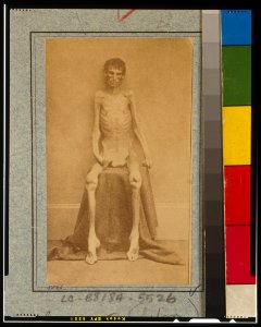 Unidentified emaciated prisoner of war, from Belle Isle, Richmond, at the U.S. General Hospital, Div. 1, Annapolis LCCN2013645513