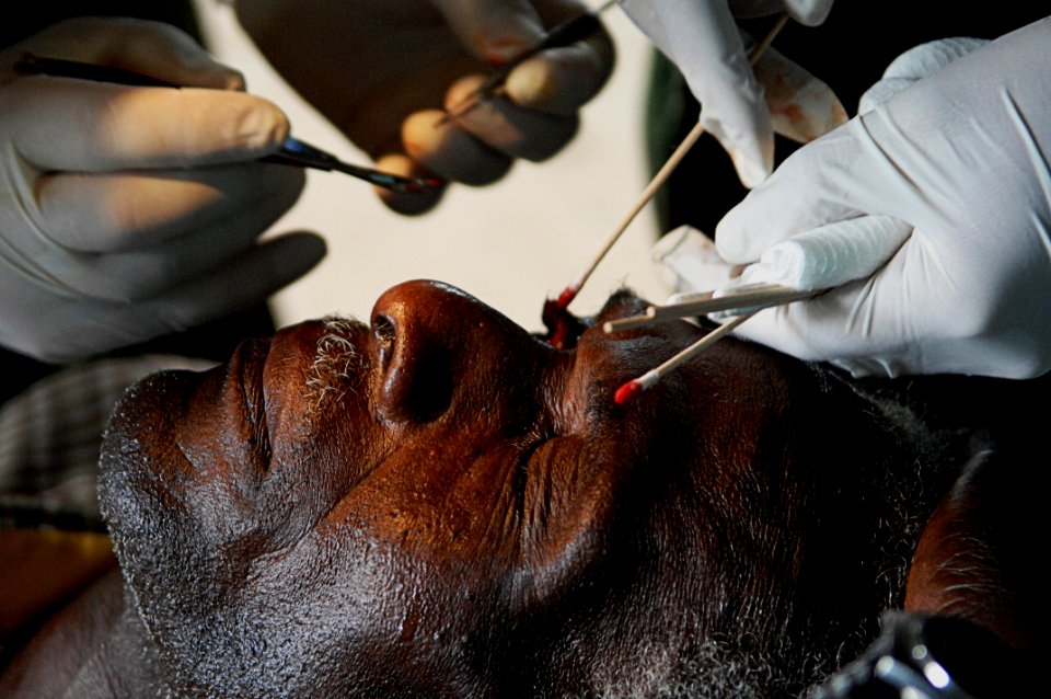 US Navy 080813-N-7544A-124 Cmdr. Brian A. Alexander and Hospital Corpsman 3rd Class Richard J. Utley perform eye surgery on Nicaraguan citizen Edwin Moore during a Continuing Promise 2008 humanitarian assistance project